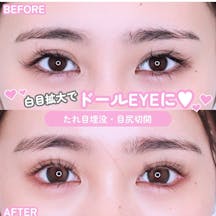 【女性・目元】たれ目埋没・目尻切開_before_aftar