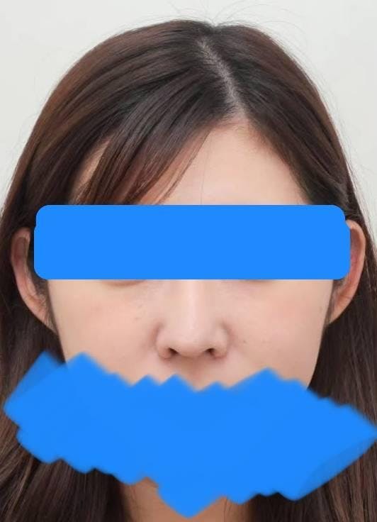 湘南美容クリニック 原宿院で隆鼻術：SBCプレミアムソフトプロテーゼを受けたみみさんの写真