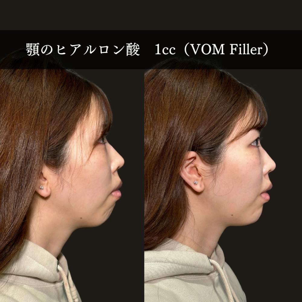 【20代女性・顎】ヒアルロン酸注射_before_aftar