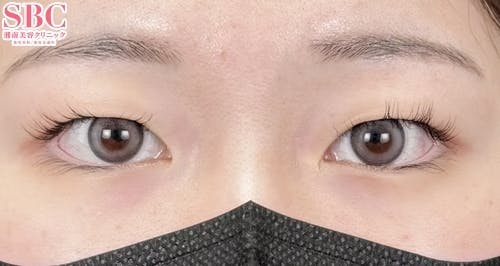 【女性・目元】クイックコスメティーク・トリプルNeo_before