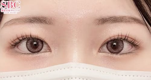 【女性・目元】クイックコスメティーク・トリプルNeo_after