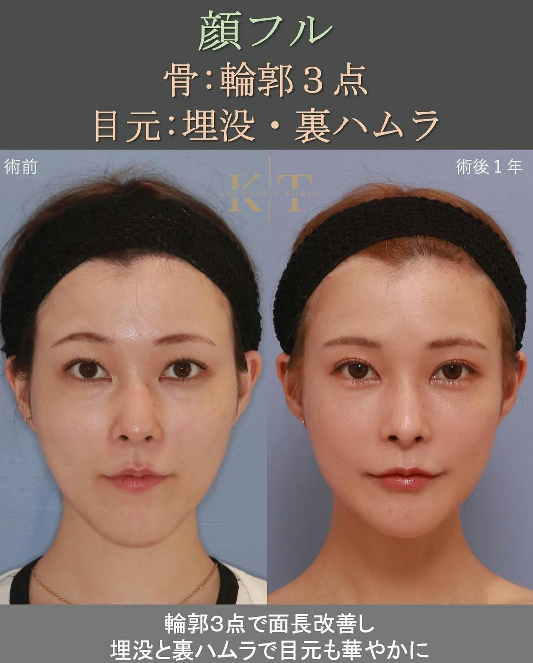 【女性・顔・目】輪郭3点・二重埋没・裏ハムラ_before_aftar