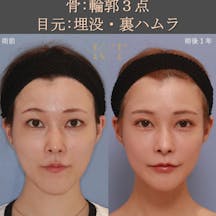 【女性・顔・目】輪郭3点・二重埋没・裏ハムラ_before_aftar