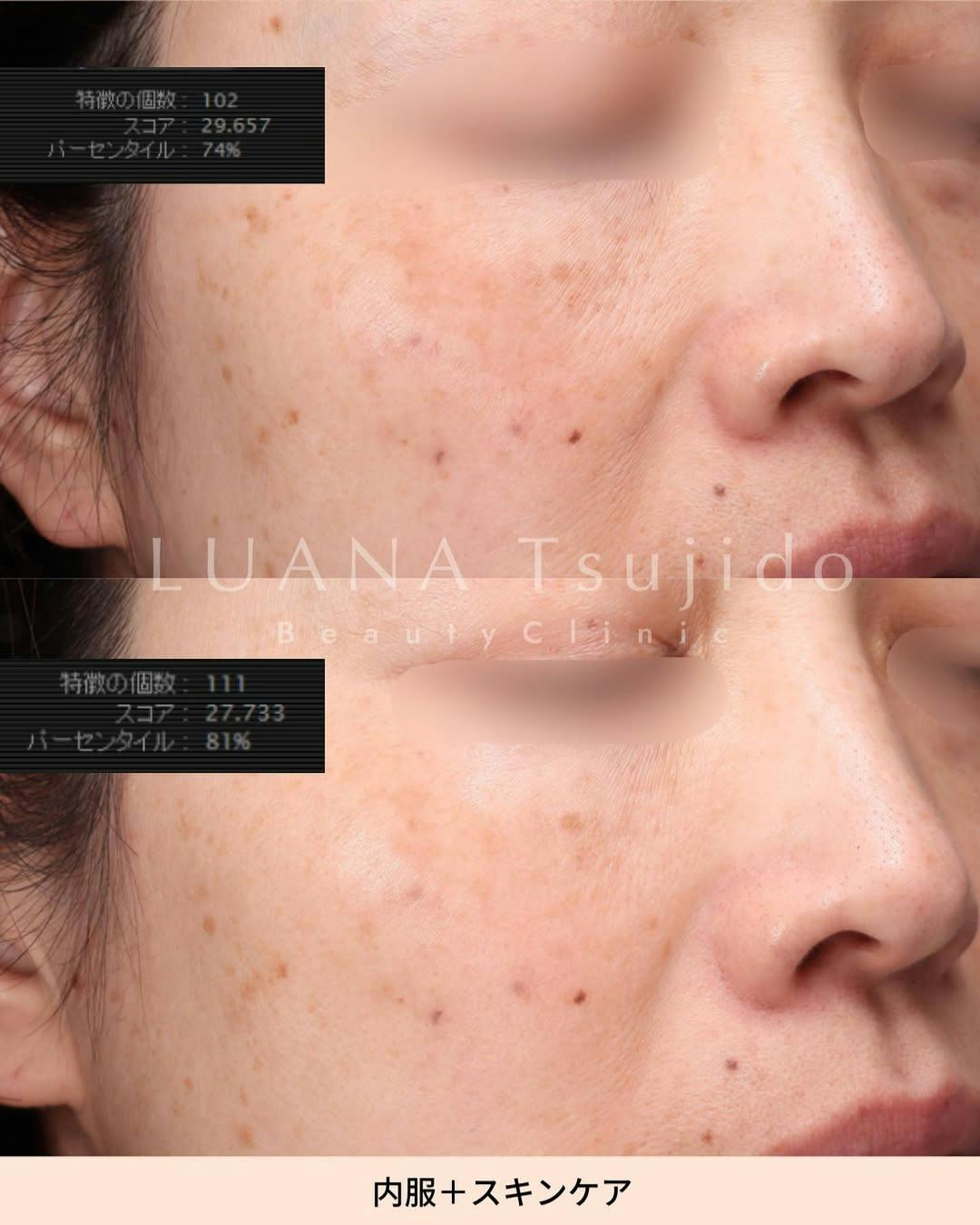 【女性・顔】内服+スキンケア_before_aftar