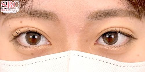 【20代女性・目元】週末二重(R)_aftar