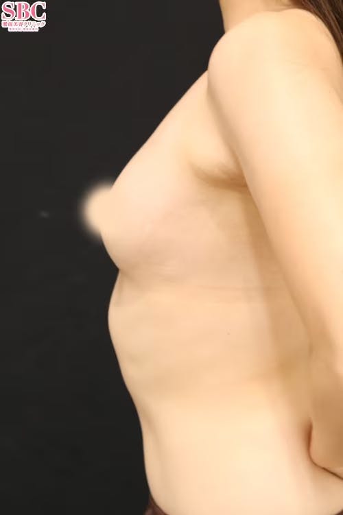 【30代前半女性・胸】セルーション(脂肪注入豊胸)、コールマン式、3Dプレミアム注入法（垂直注入法）（脂肪注入豊胸オプション）_before