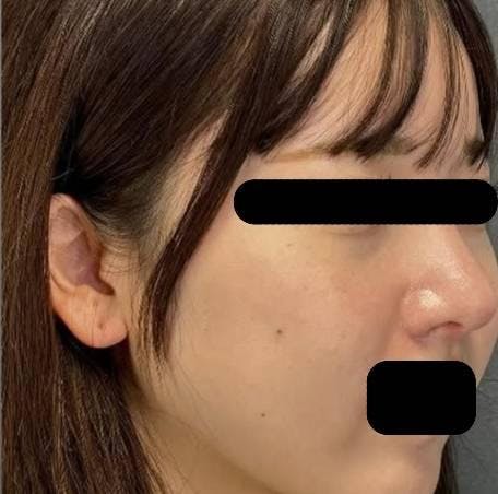 ヴェリテクリニック 銀座院で鼻の整形：鼻尖縮小術を受けたドンさんの写真