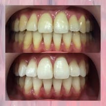 【歯】オフィスホワイトニング_before_aftar