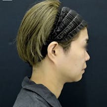 【女性・小顔】美ボディ脂肪吸引_before