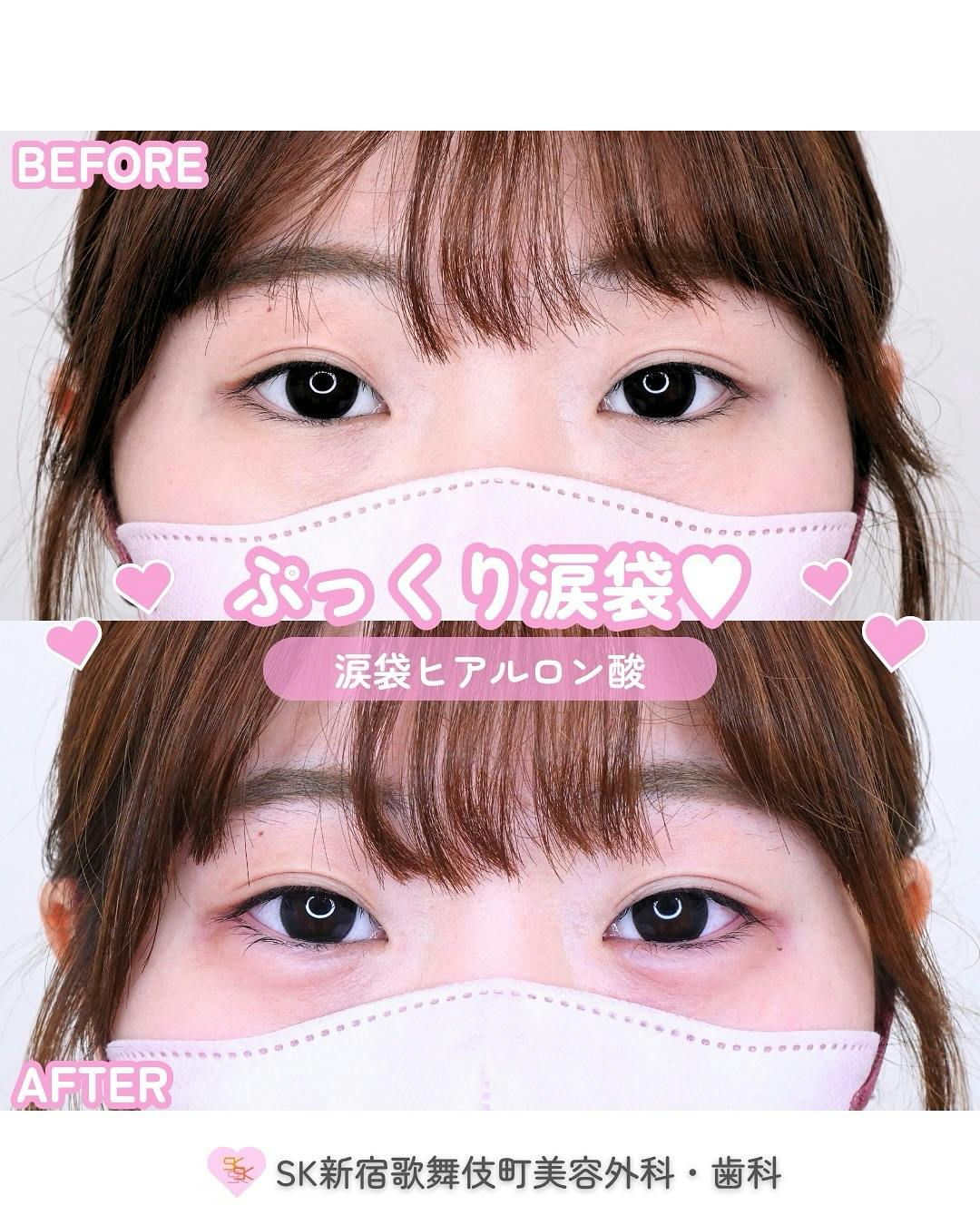 【女性・目元】涙袋ヒアルロン酸_before_aftar