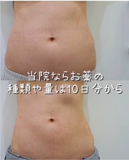 【女性・腹部】リベルサス・カナグル・サノレックス_before_aftar