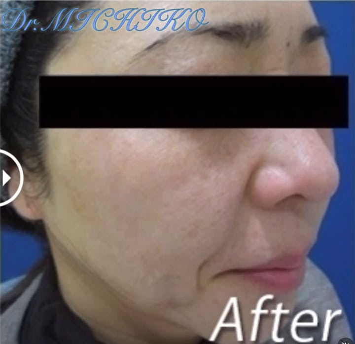 【女性・シミ】フォトSR_before