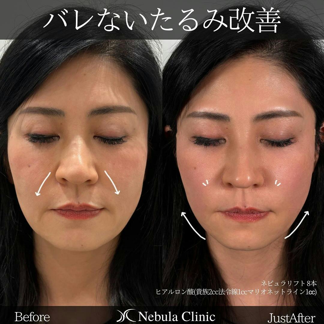 【女性・顔・小鼻・法令線・マリオネットライン】糸リフト、ヒアルロン酸注入(貴族・法令線・マリオネットライン)_before_aftar