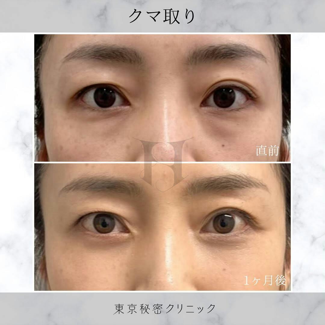 【女性・目元】クマ取り_before_aftar