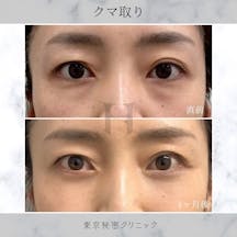 【女性・目元】クマ取り_before_aftar