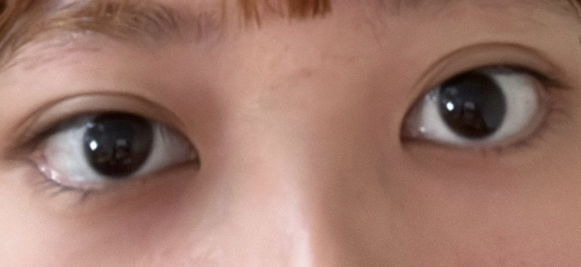 TCB東京中央美容外科 仙台駅前院でヒアルロン酸注射・注入・涙袋ヒアルロン酸注射・ニューラミスを受けたaさんの写真