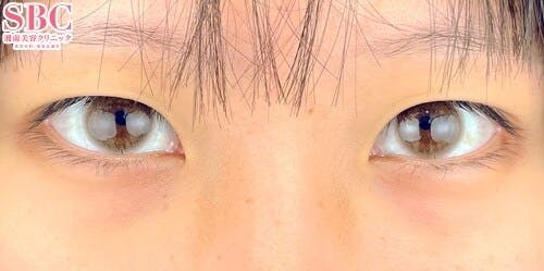 【女性・目元】クイックコスメティーク・ダブルNeo、目頭切開プレミアム、自然癒着セット（上眼瞼脱脂）_before