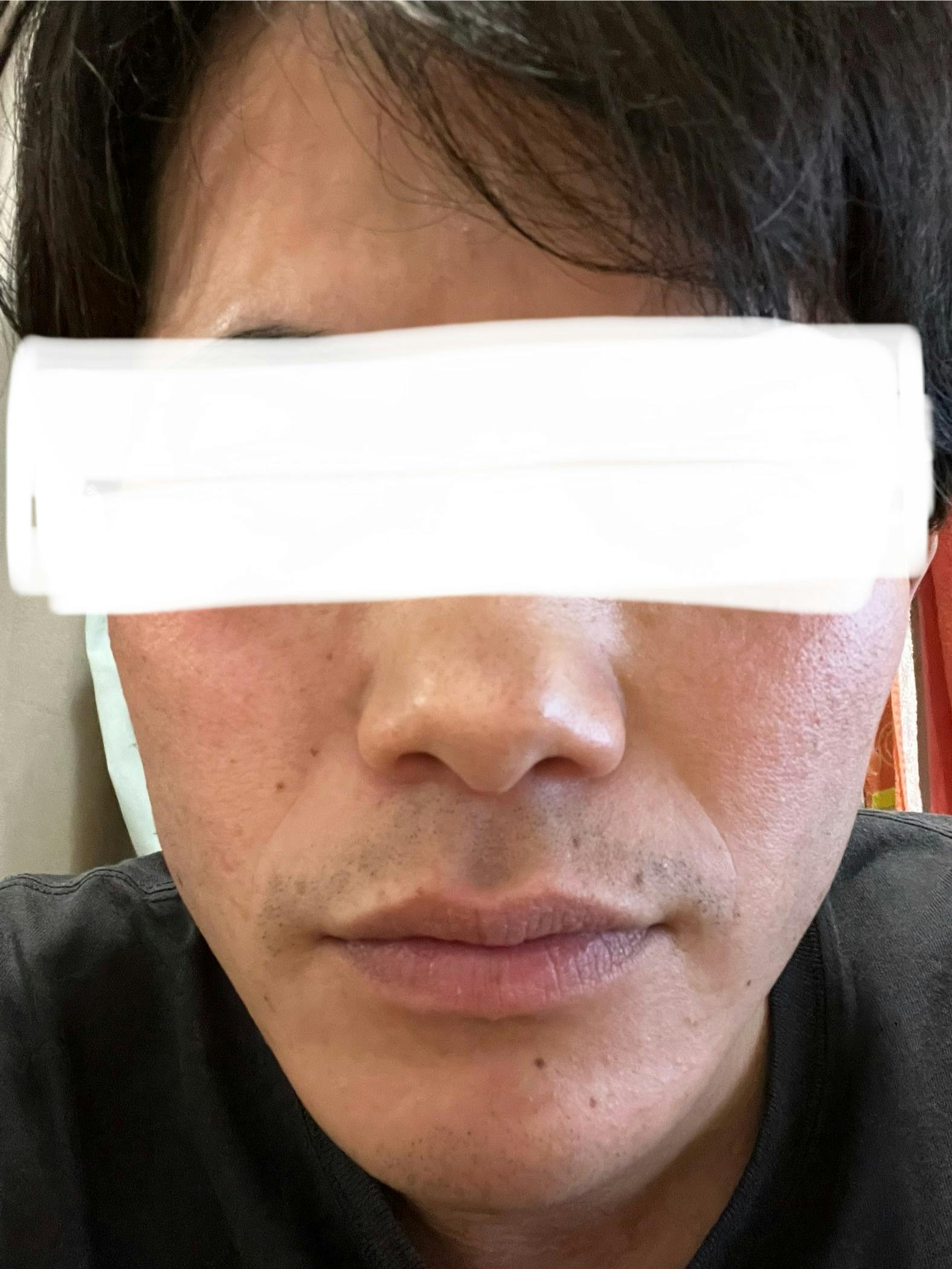 湘南美容クリニック 名古屋駅本院でを受けたひろちゃんさんの写真