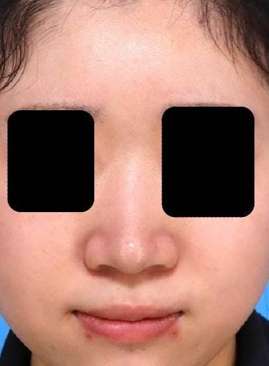 品川美容外科銀座院でプレミアム隆鼻術：ダンゴ鼻（鼻先）修整を受けた柏餅さんの写真