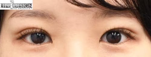 【29歳女性・目元】グランドループ法_1week