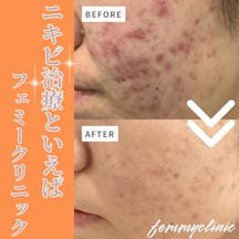 フェミークリニック 池袋院_before_aftar