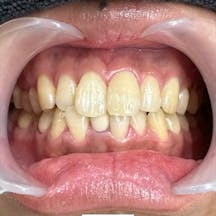 【歯】ホワイトニング_aftar