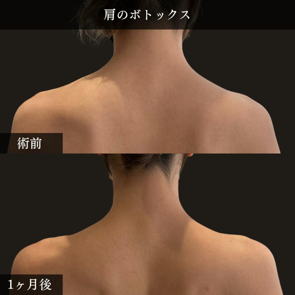 【20代女性・肩】肩のボトックス注射_before_aftar