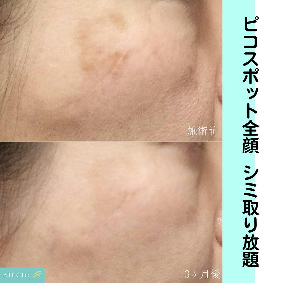 【女性・シミ】ピコスポット全顔_before_aftar