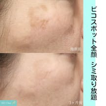 【女性・シミ】ピコスポット全顔_before_aftar