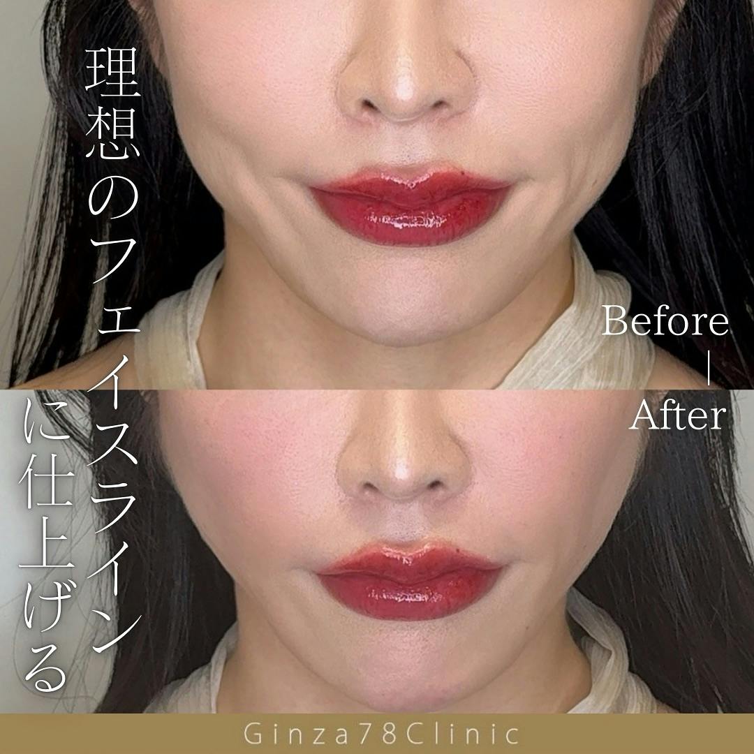 【女性・小顔】糸リフト_before_aftar