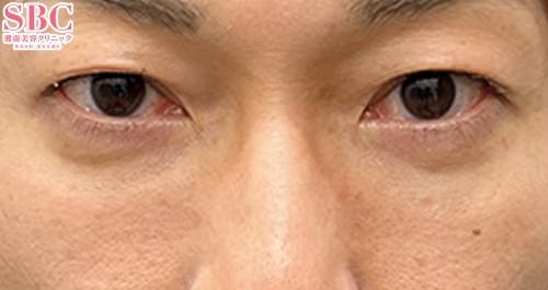 【30代男性・たるみ】目の下の切らないクマ・たるみ（ふくらみ）取り、ナチュラル脂肪注射コンデンスリッチ_after