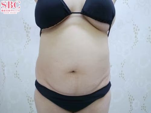 【女性・腹部】根こそぎVASER脂肪吸引、ライポマティック脂肪吸引、Aquicell（アキーセル）脂肪吸引_before