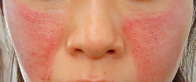 大西皮フ科形成外科医院 滋賀大津石山院でを受けたmoosanさんの写真