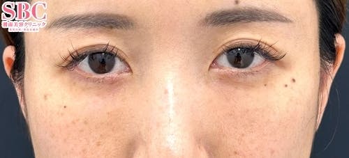 【30代女性】目の下の切らないクマ・たるみ(ふくらみ)取り・ナチュラル脂肪注射ナノリッチ・コンデンスリッチ_after