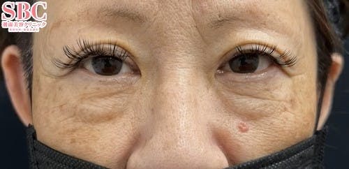 【50代女性・たるみ】目の下の切らないクマ・たるみ（ふくらみ）取り_before