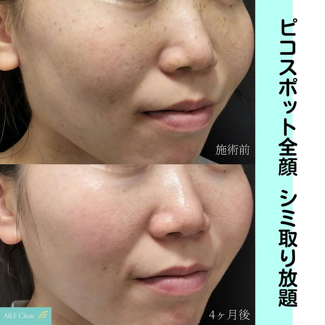 【女性・シミ】ピコスポット全顔_before_aftar