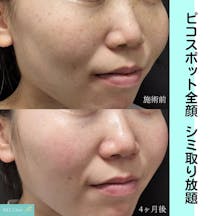 【女性・シミ】ピコスポット全顔_before_aftar