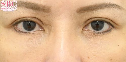 【40代女性・シワ】リジュランi_after