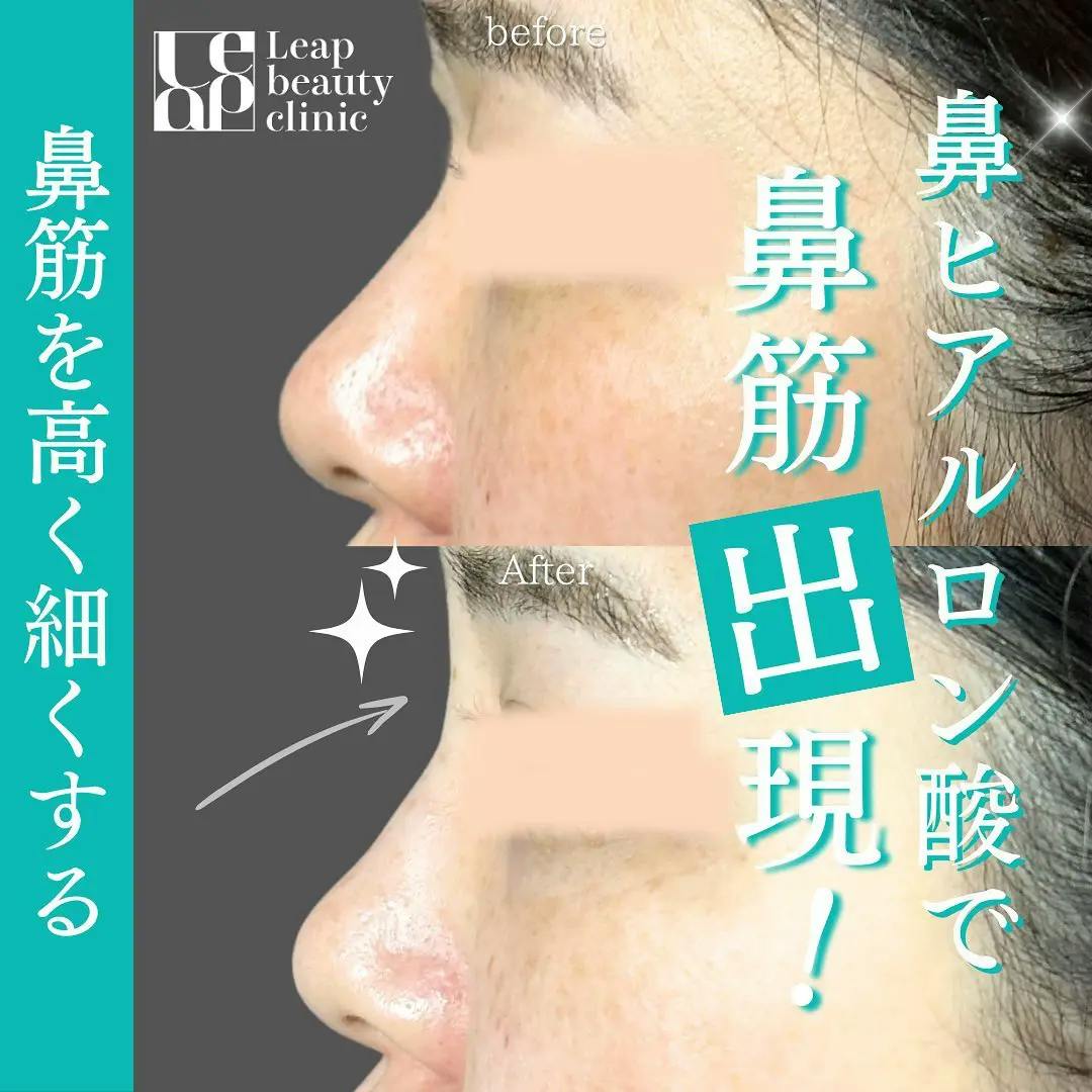 【20代女性・鼻】鼻ヒアルロン酸_before_aftar