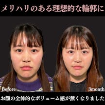 【20代女性・顔】脂肪吸引プレミアム(頬・顎下)+メーラーファット除去+ウルトラソフト_before_aftar