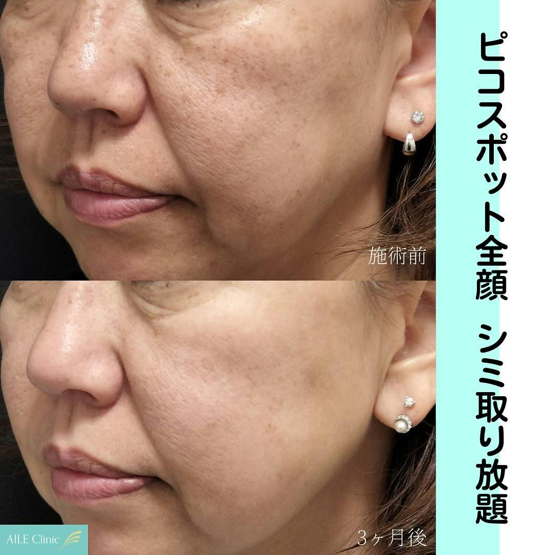 【女性・シミ】ピコスポット全顔_before_aftar