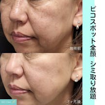 【女性・シミ】ピコスポット全顔_before_aftar