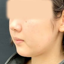 【30代女性・顔】顔の脂肪吸引、VOVリフト_before