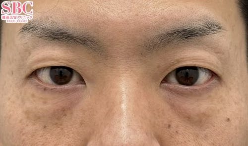 【30代男性・目元】目の下の切らないクマ・たるみ（ふくらみ）取り、ナチュラル脂肪注射_before