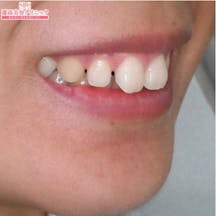 【歯】ホームホワイトニング マウスピース矯正_before