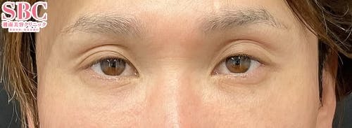 【30代男性・目元】目の下の切らないクマ・たるみ（ふくらみ）取り、ナチュラル脂肪注射コンデンスリッチ、ナチュラル脂肪注射ナノリッチ_after