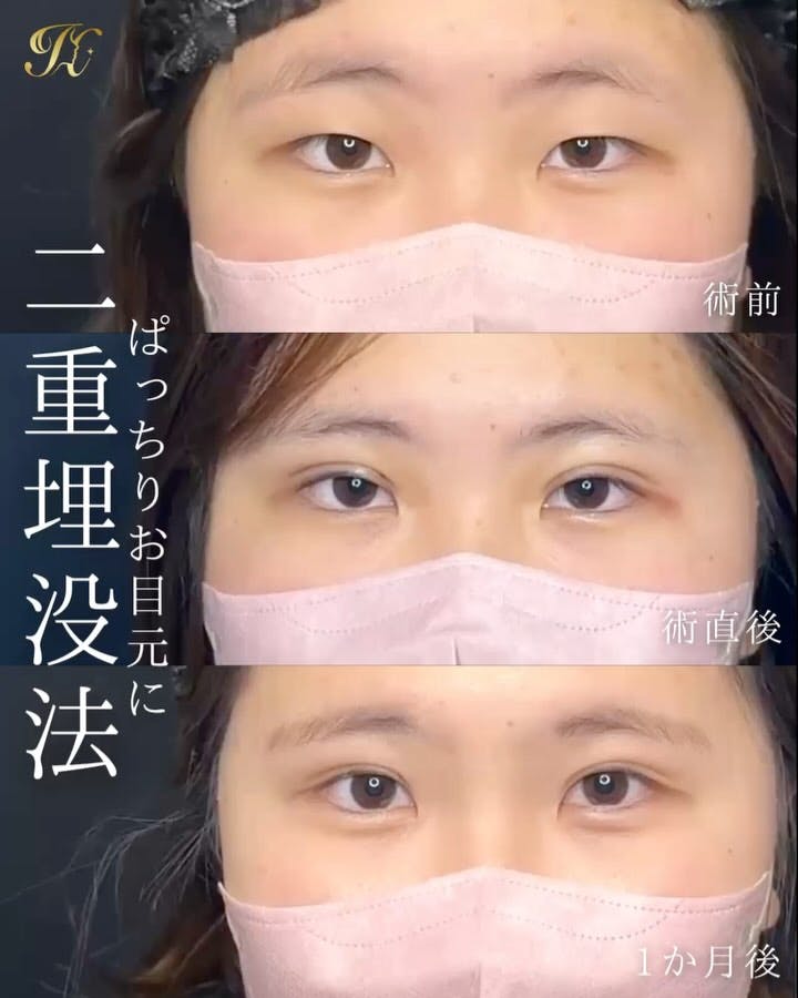 【女性・目元】HBC式二重埋没法_before_aftar