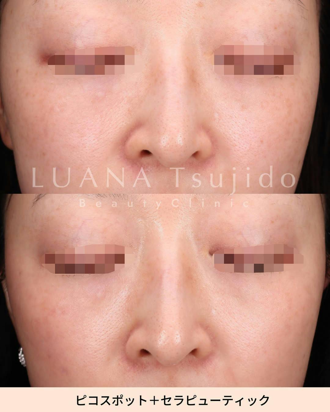 【女性・顔】ピコスポット＋セラピューティック(ガウディスキン)_before_aftar