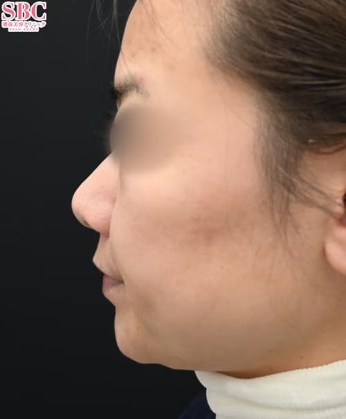 【女性・輪郭】ヒアルロン酸_before