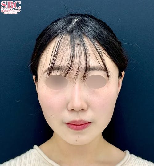 【20代女性・顔・頬】小顔用脂肪吸引注射・メーラーファット除去術_after